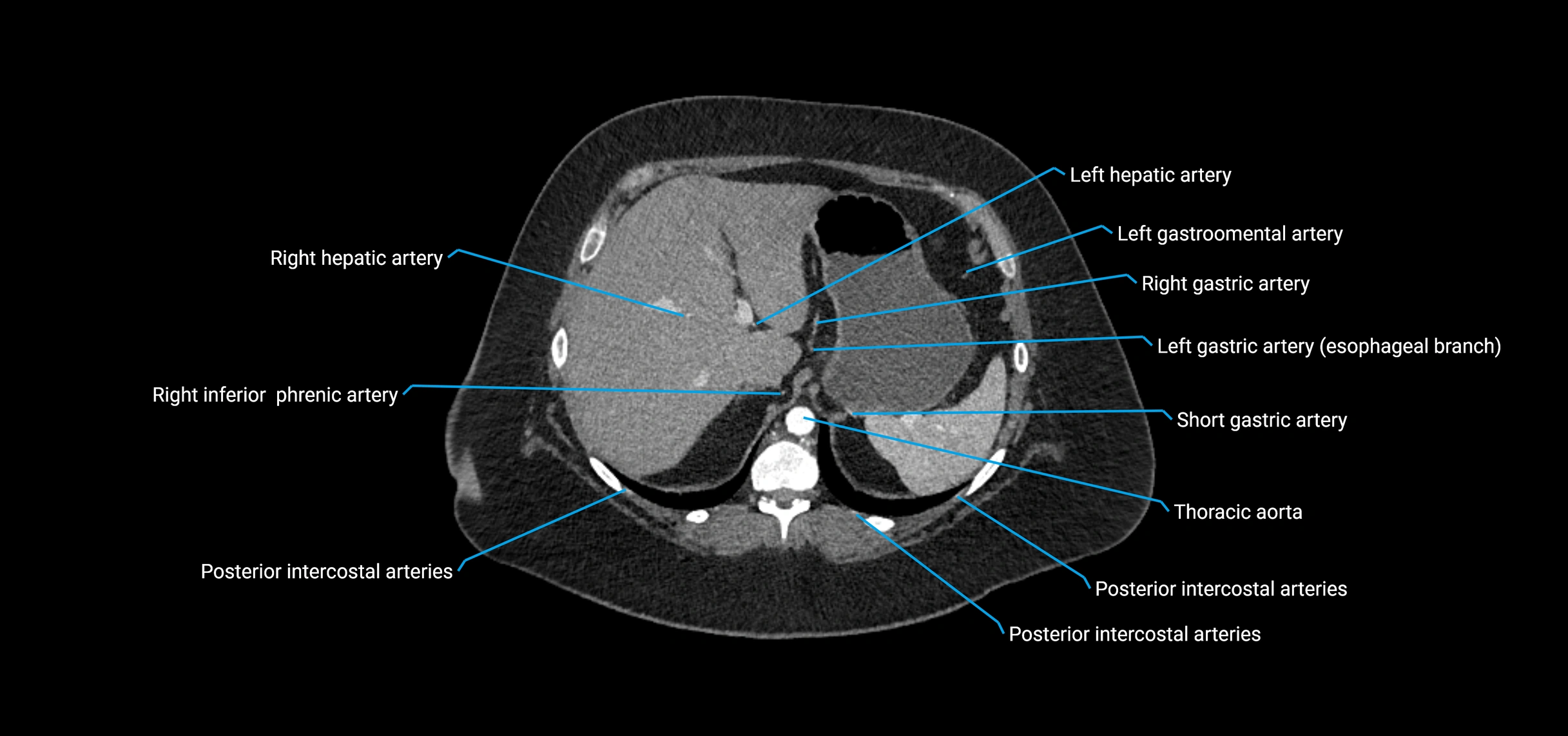 CTA abdomen axial cross sectional anatomy labelled image_37 (2).webp
